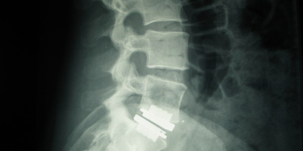 Specialized Lumbar Disk Replacement Relieves Back Pain, Preserves Mobility