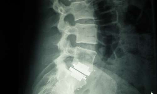 Specialized Lumbar Disk Replacement Relieves Back Pain, Preserves Mobility